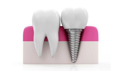 Remplacement d'une dent par
une racine artificielle et couronne Remplacement d'une dent par
une racine artificielle et couronne
